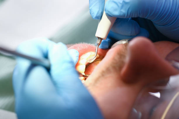 Best Emergency Root Canal Treatment in Marble Hill, MO