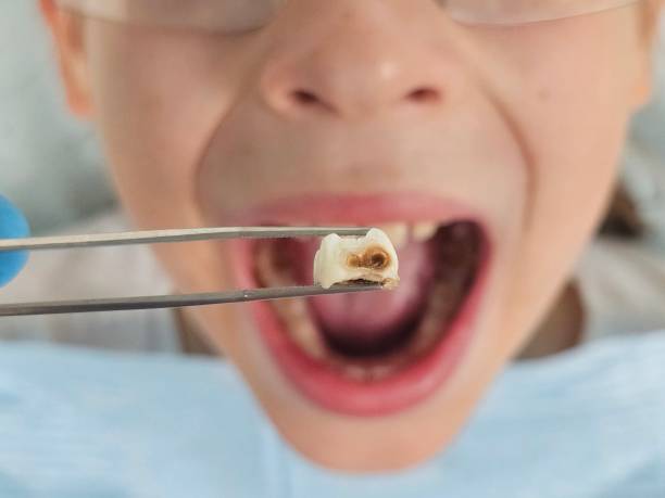 Best Broken or Cracked Tooth Emergency Dentist in Marble Hill, MO